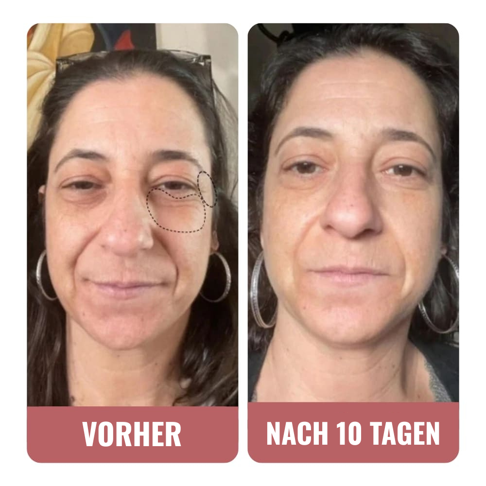 Meine Augenpartie ist glatter und weniger dunkel.